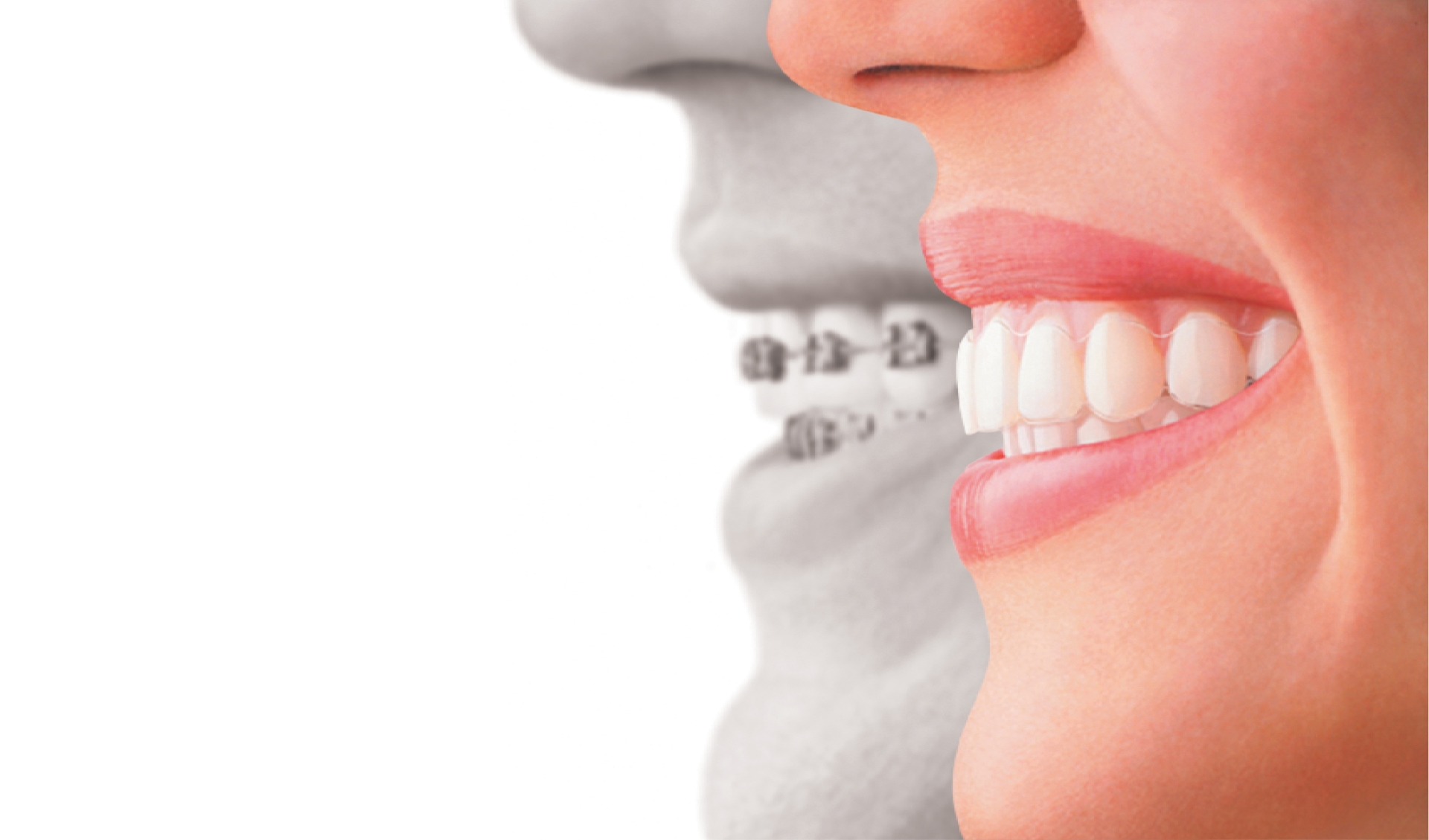 Invisalign vs. Braces: Making the Right Choice for Your Smile in Stouffville 